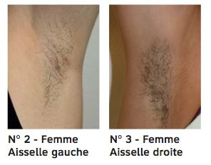 ex1 7 semaines après la dernière épilation à la cire