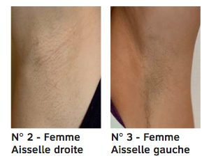 ex2 Au bout d'un an, sept semaine après le dernier flashage avec l'E-One